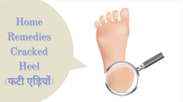 फटी एड़ियों से छुटकारा पाएं केवल 2 दिन में (Home Remedies for Cracked Heel In Hindi)