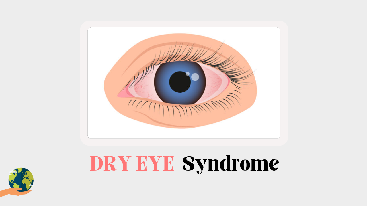 Dry Eye Syndrome: आँखों में सूखापन और थकान से कैसे बचें?